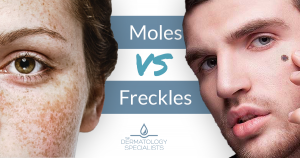 How To Tell The Difference Between A Mole And A Freckle The Dermatology Specialists