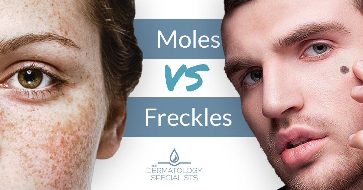 difference between moles and freckles