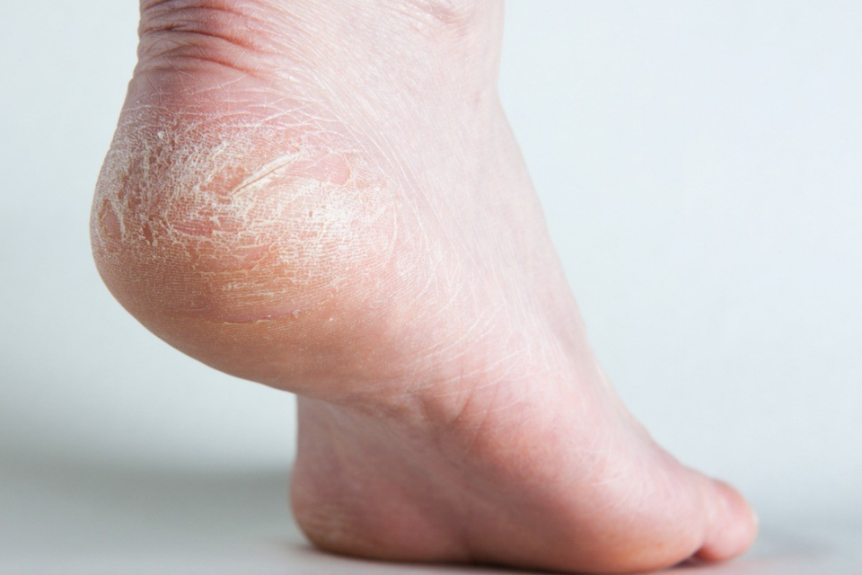 cracked skin on sole of foot