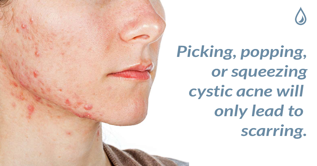 acne on jaw and neck