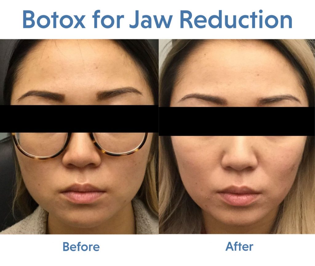 botox jaw reduction