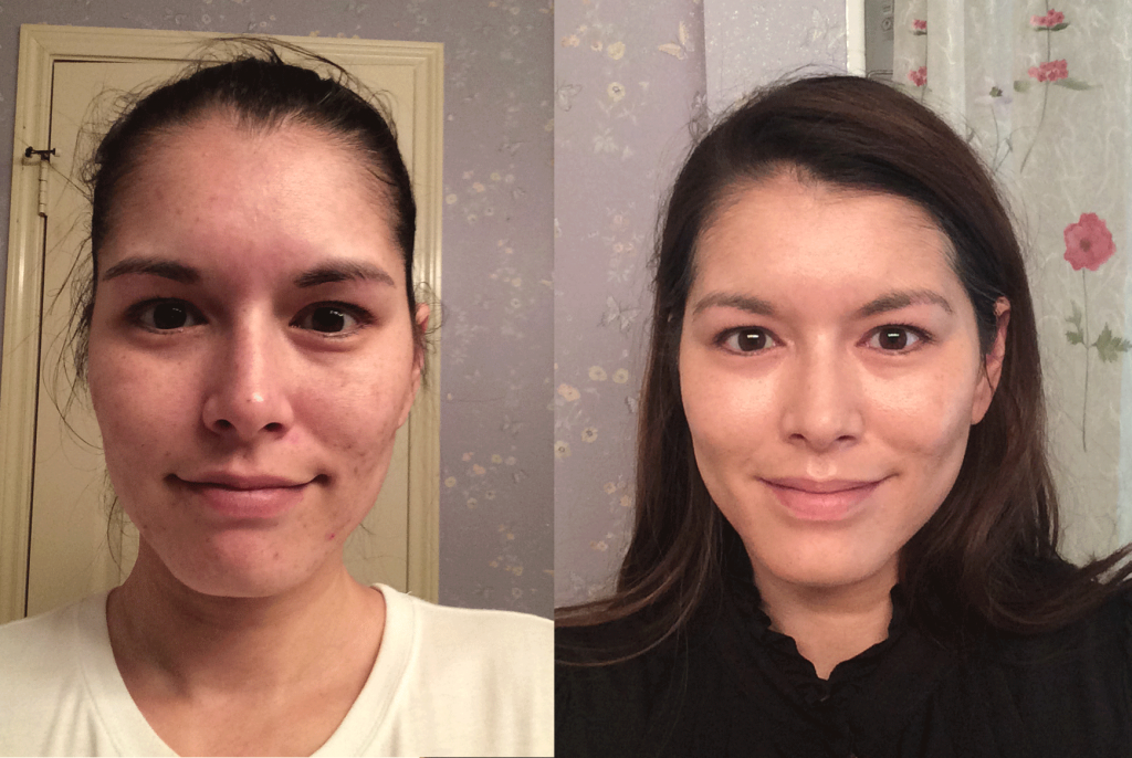 tretinoin before and after