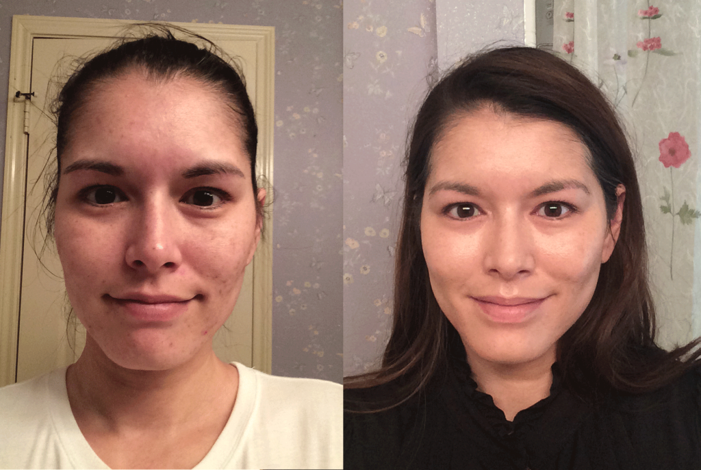 How To Fully Benefit From Tretinoin For Anti Aging Treatment The 