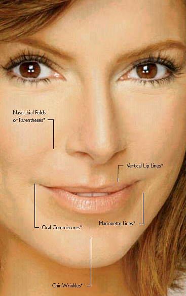 fillers for acne scars
