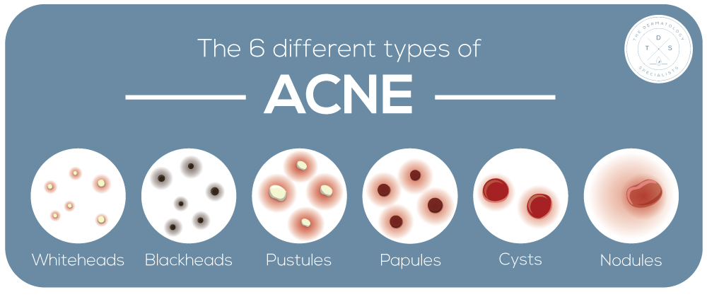 The 6 kinds of acne, The Dermatology Specialists