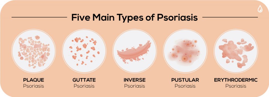 5 Main Types of Psoriasis - The Dermatology Specialists