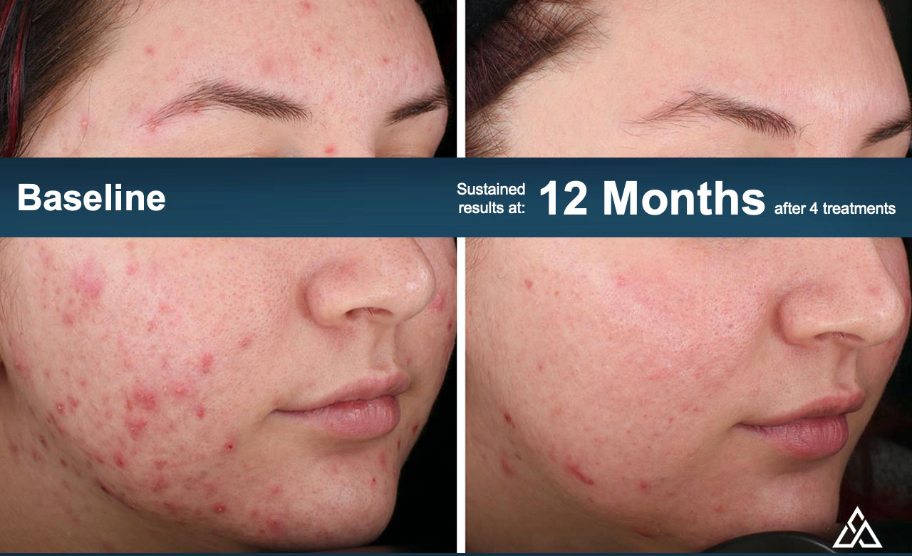 before and after image of patient who received the accure laser acne treatment